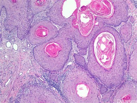 鳞状细胞癌图片