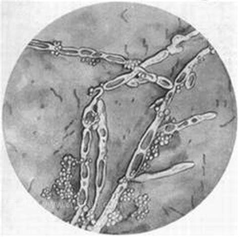 霉菌性阴炎症状图