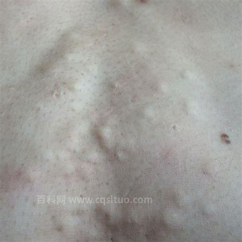 皮下脂肪瘤图片