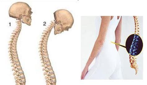 脊柱炎的早期症状有哪些
