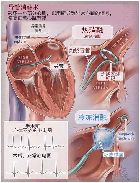 心脏射频消融术是个坑