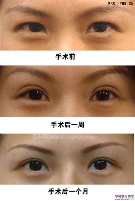 韩式双眼皮手术