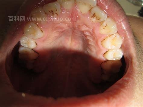 大牙牙龈肿了个肉坨怎么办不疼