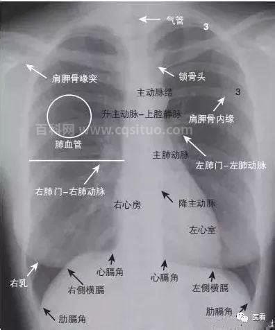 胸部双侧膈面光滑肋膈角锐利什么意