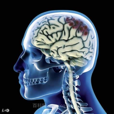 脑出血背部引流有什么作用？