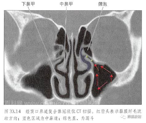 窦口鼻道复合体指的是什么