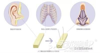 自体软骨隆鼻