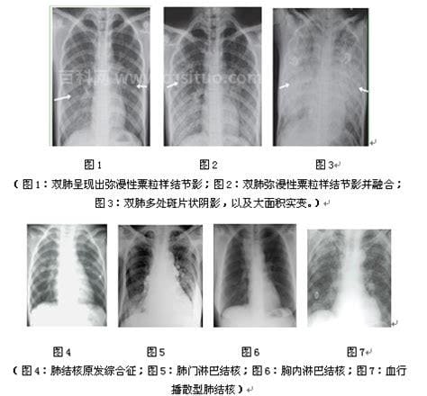 肺结核分型 肺结核的五大分型