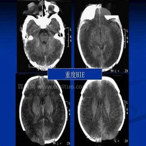 什么是缺氧缺血性脑病 缺氧缺血性脑病这样治疗