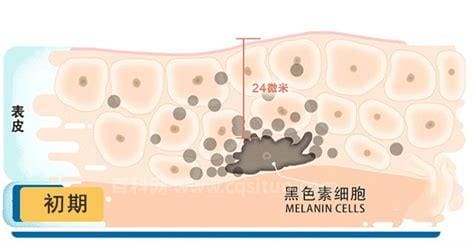 皮肤色斑形成的原因及影响因素