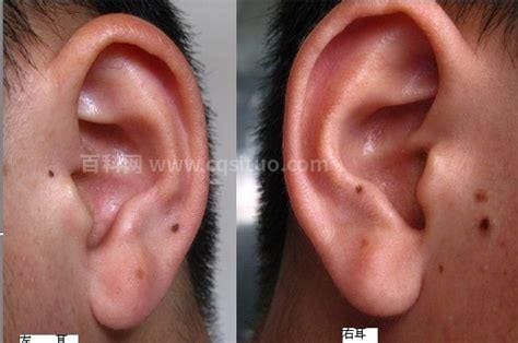 耳朵上有痣代表什么