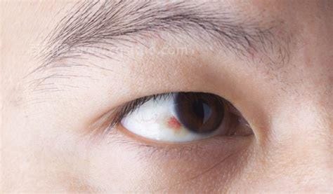 眼睛发痒预示哪些眼病？该怎么治？