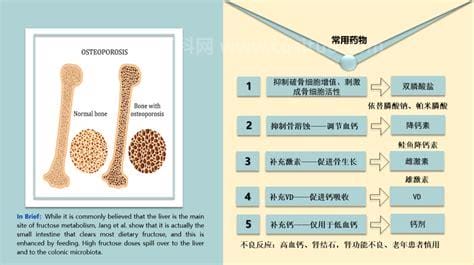 单纯补钙能治骨质疏松吗？