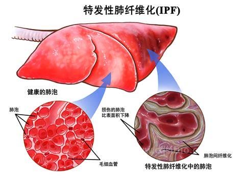 特发性肺纤维化(IPF)世界周：拯救“蜂窝肺”，宜早不宜迟