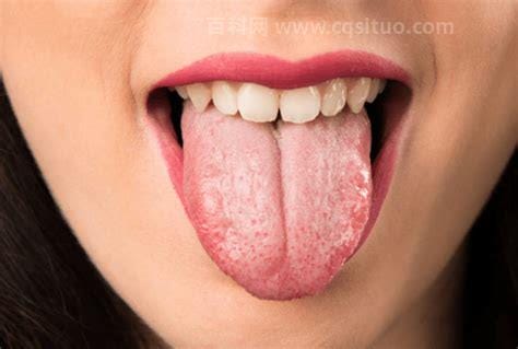 舌头发黄是什么原因引起