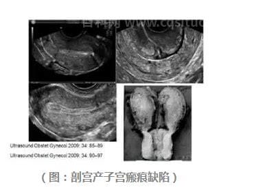 疤痕子宫是什么意思