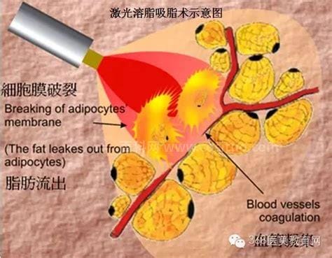 激光溶脂效果