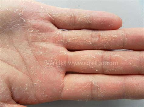 水疱型手癣和汗疱疹