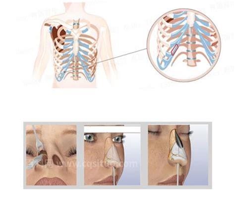 肋软骨隆鼻手术要好多钱