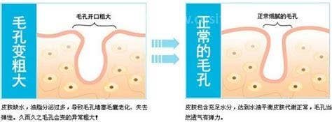 激光能收缩毛孔吗收缩毛孔的方法有哪些