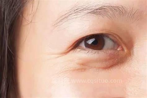 眼角细纹怎么消除呢