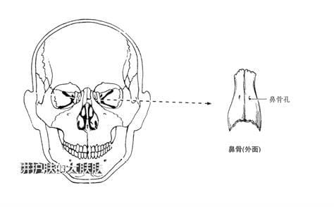 鼻梁骨矫正