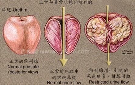 前列腺炎是什么意思