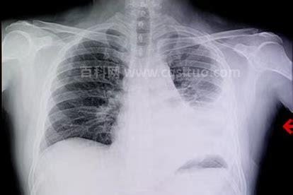 大白肺一般能维持几天