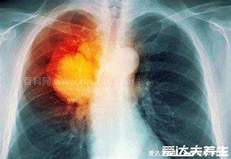 肺癌晚期最怕三个征兆，出现这些表示活不过3个月