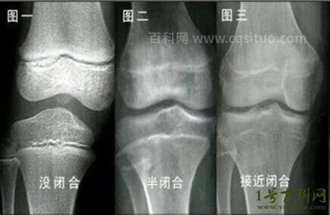 8个征兆说明停止长高，皮肤上出现紫色或白色条纹