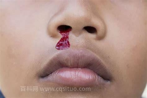 白血病早期流鼻血特点，流鼻血怎么排除是白血病