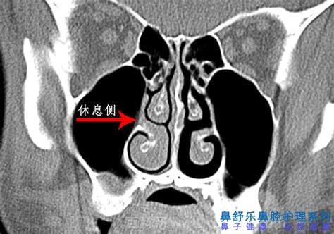 鼻塞是新冠的第几个阶段，大概属于第三阶段