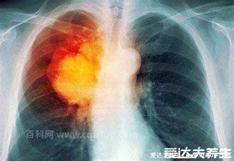 肺部感染最怕三个征兆，饮食减少/呼