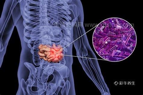 4个最为明显的肠癌信号，小心腹痛和腹胀/便血/贫血优质
