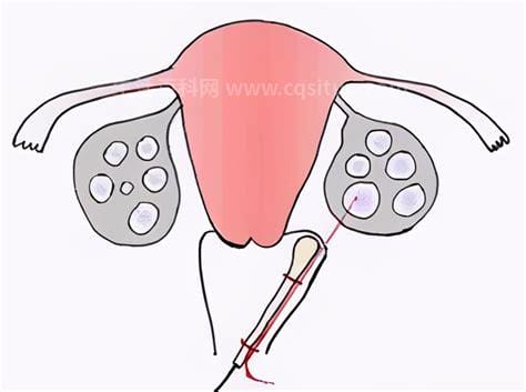 7个症状暗示卵巢早衰，别把腹胀/长斑