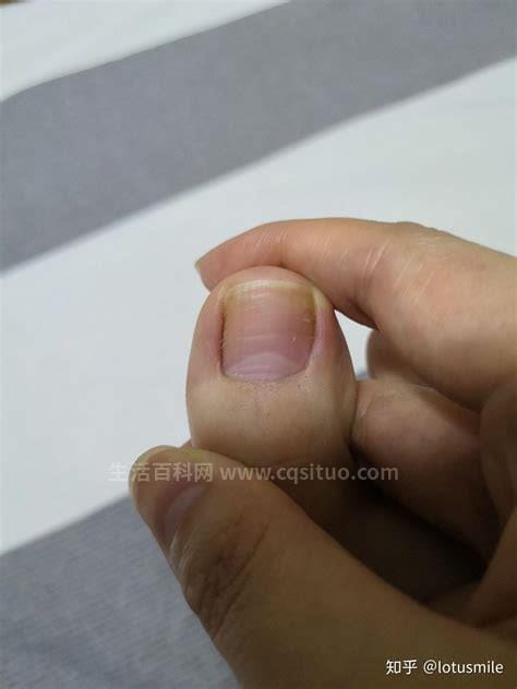 灰指甲早期症状图片，出现侧弯曲或是向长得变形等情况优质