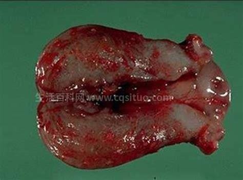 子宫内膜脱落真正图片，女性月经时掉下一块肉一样的东西优质