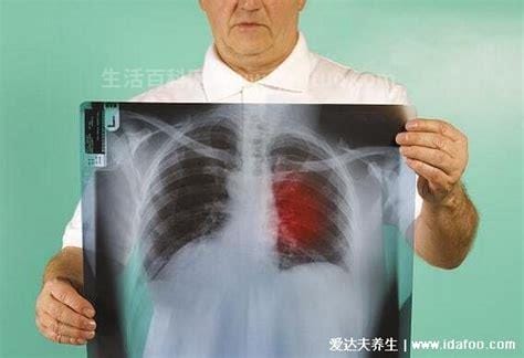 体检尽量别做肺部ct，5类人体检尽量