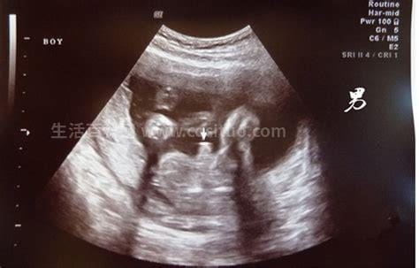 胎儿几个月不会畸形了，3个月后基本