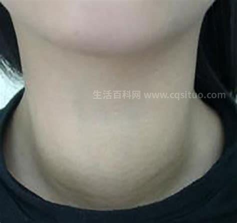甲亢脖子肿大的位置图，脖子有异常变粗还有凸起肿块优质