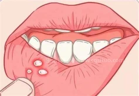 口腔溃疡偏方一次就好，8个治疗口腔溃疡小窍门优质