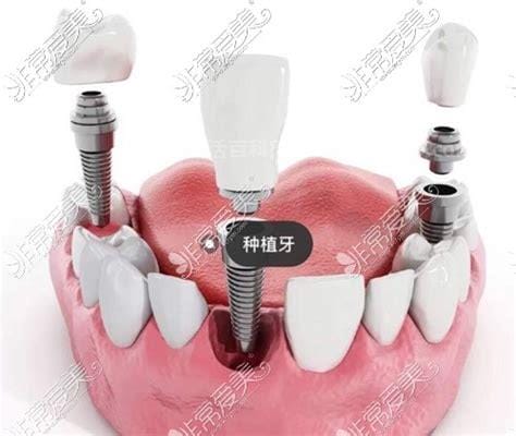 种植牙的八个后遗症，种植牙须小心这