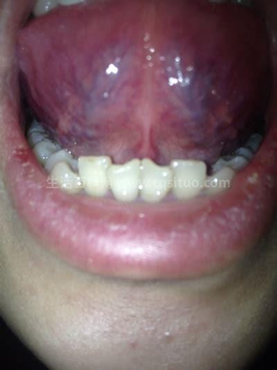 口腔尖锐湿疣图片及症状，初期舌下长