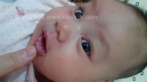 婴儿鹅口疮最早期图片，白色斑块有粘