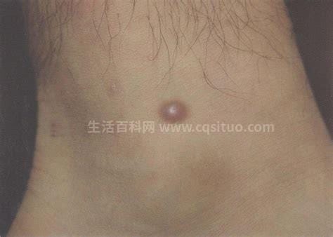 早期皮肤纤维瘤图片初期症状图，褐色