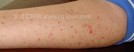 白血病的早期症状和前兆，突出表皮的小红点图片(附十种自我检查法)