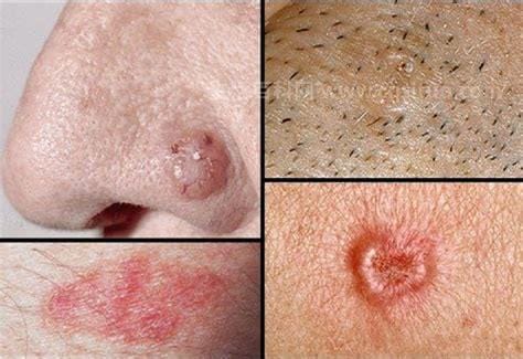 皮肤癌早期症状图片，有4种类型皮肤