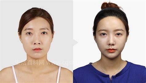 打完瘦脸针的图片效果对比，三个月脸型变化明显（附瘦脸针自测法）