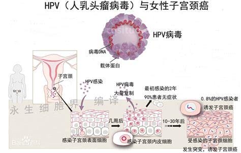 女性hpv是什么病毒图片，会导致宫颈