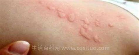 螨虫叮咬后的症状图，叮咬痕迹／皮肤炎